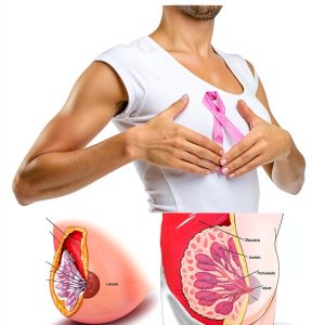 Breast Cancer Kindle Book English Health Fitness Dieting-0